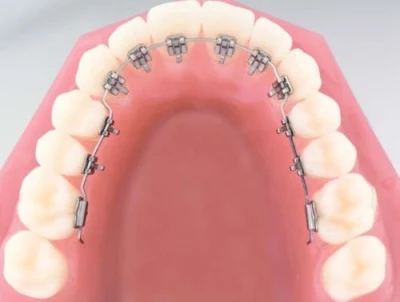 Metal Dental Lingual Brackets Orthodontic Products Mini Roth Teeth Braces